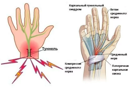 Онемение рук