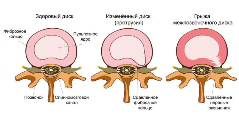 Грыжа позвоночника